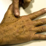 Saúde -Desinformação sobre câncer de pele afeta diagnóstico, diz instituição