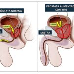 SAÚDE – Hiperplasia da próstata pode aumentar frequência urinaria dos homens
