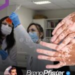SAÚDE – Cientistas da USP criaram uma nanotecnologia capaz de silenciar certos genes ligados ao vitiligo, psoríase e câncer de pele