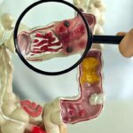 Em 13 anos, doença inflamatória intestinal cresce 5 vezes no Brasil