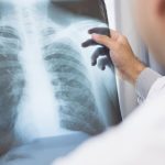 SAÚDE – Anvisa aprova novo medicamento para câncer de pulmão avançado