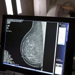 Médicos lançam guia para evitar recusa de mamografia digital
